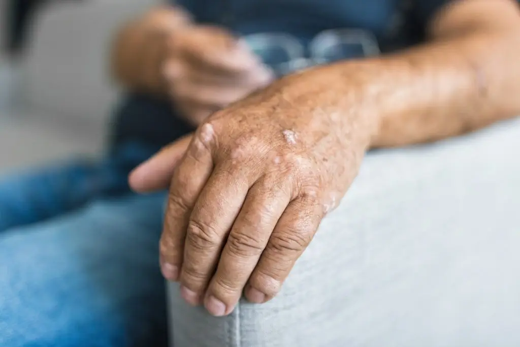 physical therapy for every type of arthritis alves & martinez
